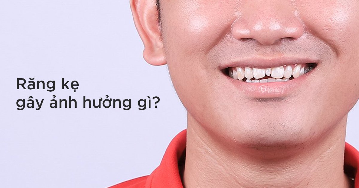 Răng kẹ gây ảnh hưởng gì?