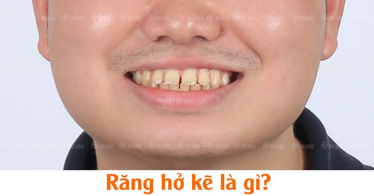 Răng hở kẽ là gì?