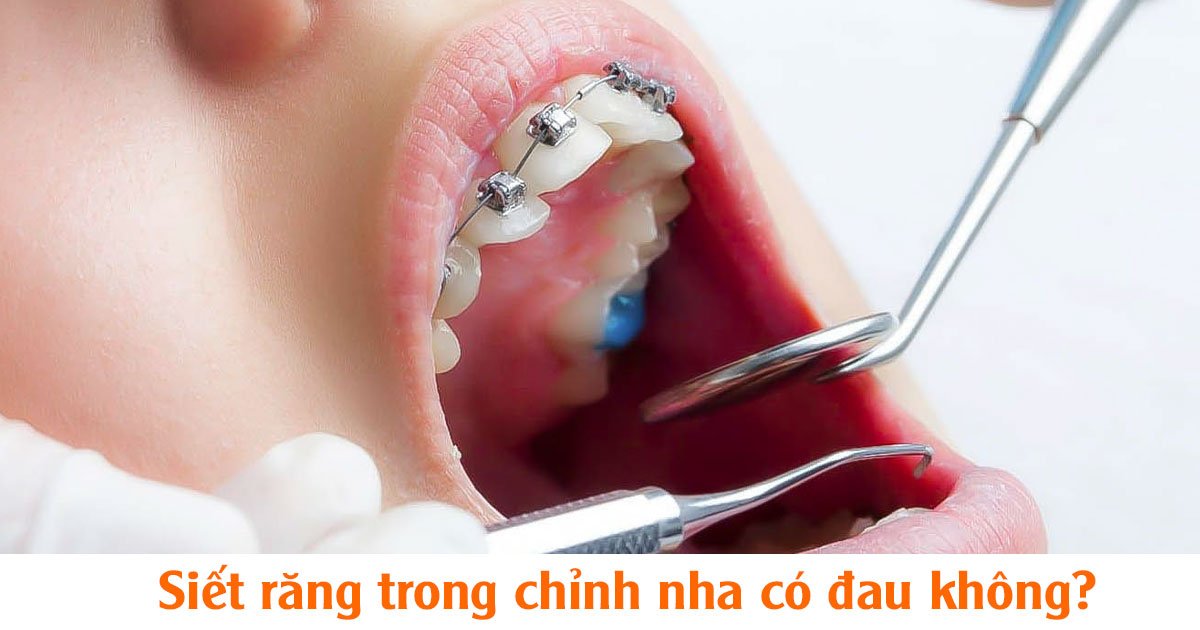 Siết răng trong chỉnh nha có đau không?