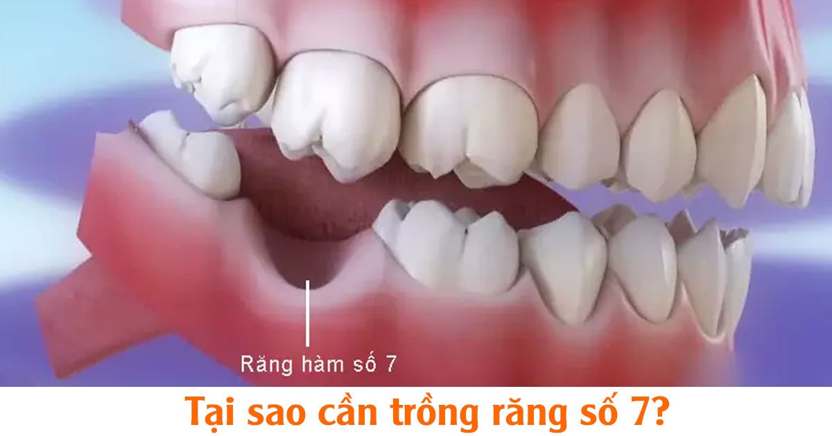 Tại sao cần trồng răng số 7?