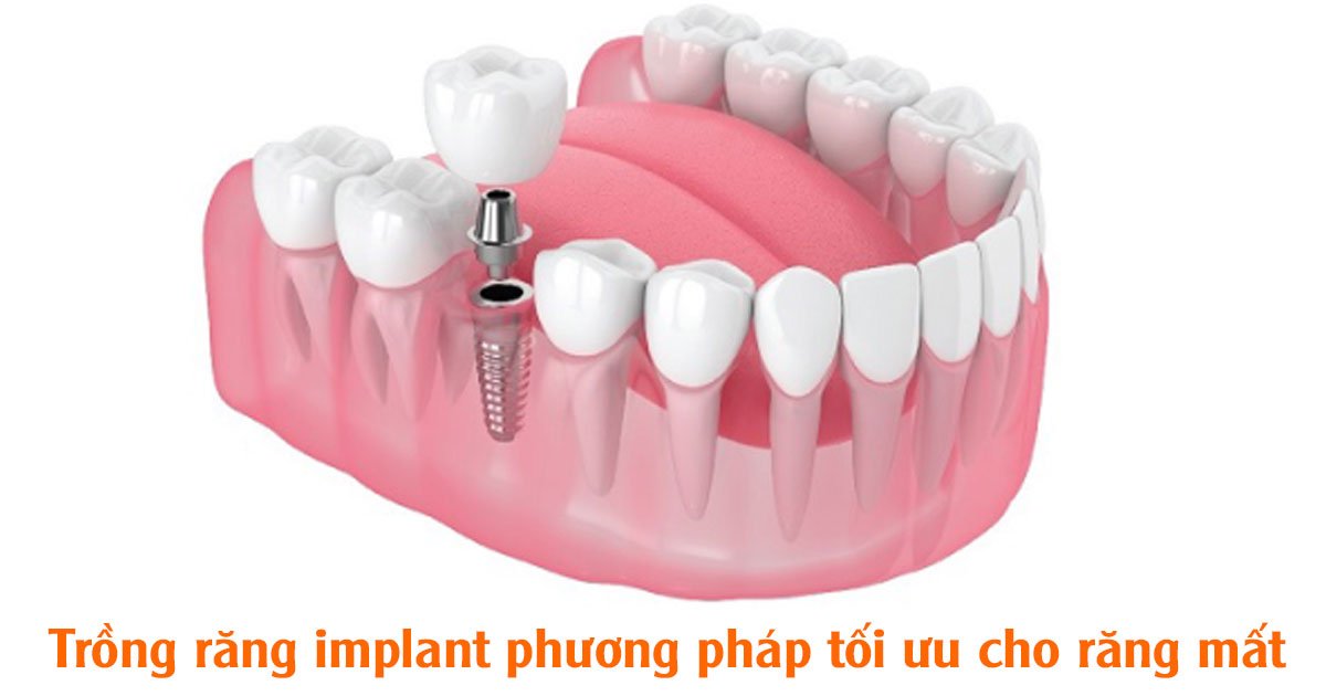 Trồng răng implant phương pháp tối ưu cho răng mất