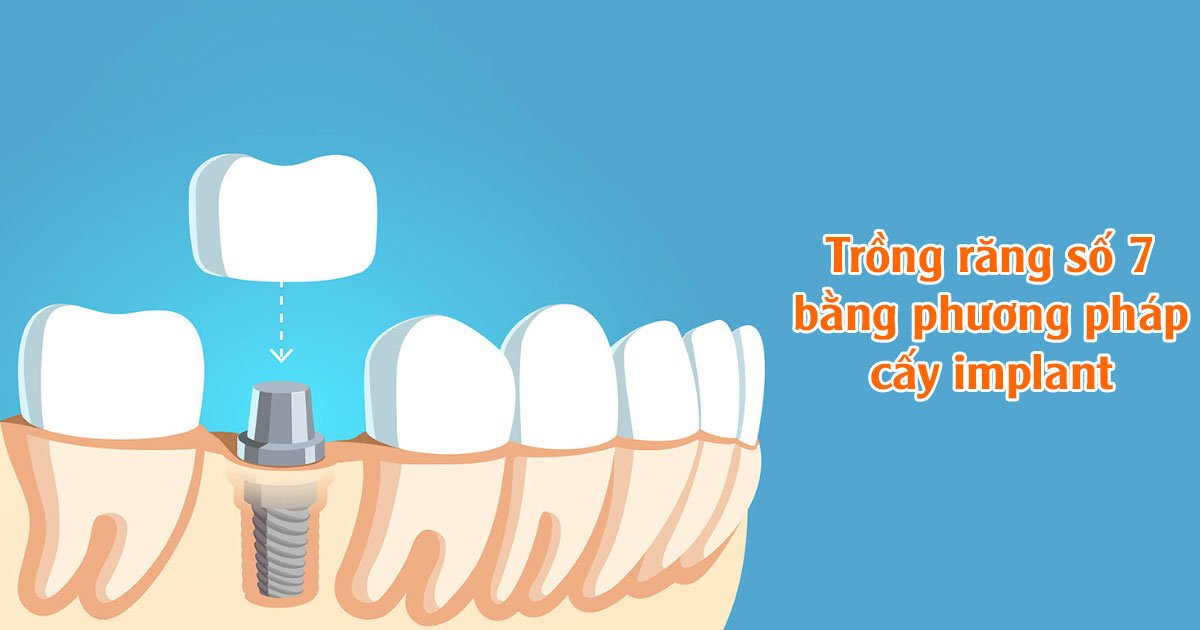 Trồng răng số 7 bằng phương pháp cấy implant
