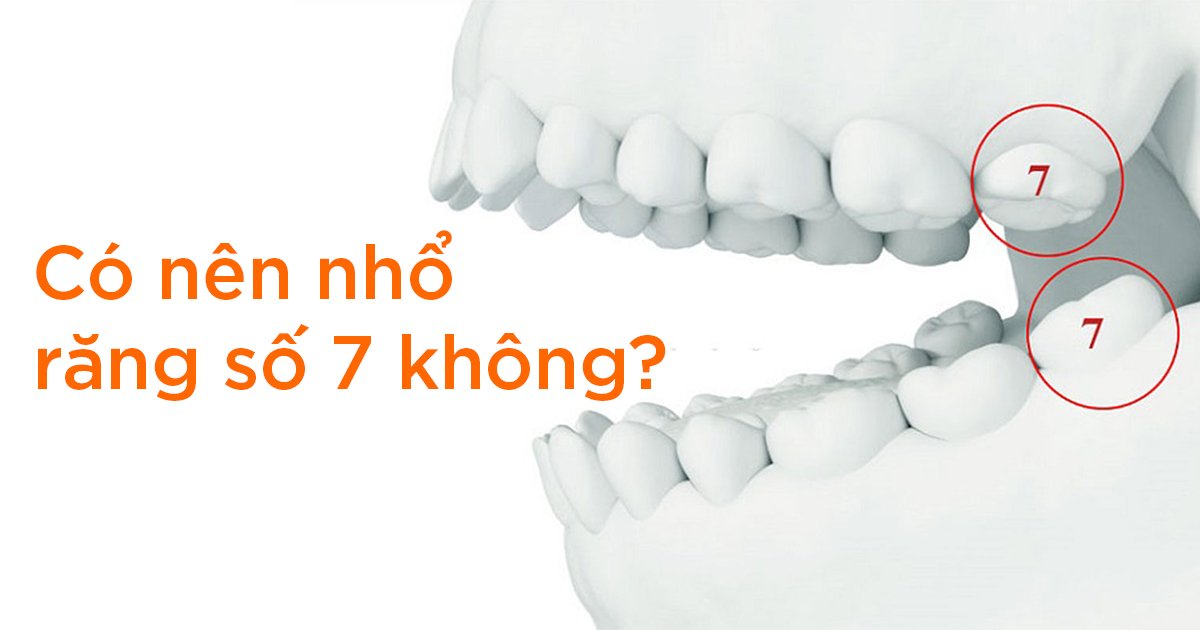 Có nên nhổ răng số 7 không?