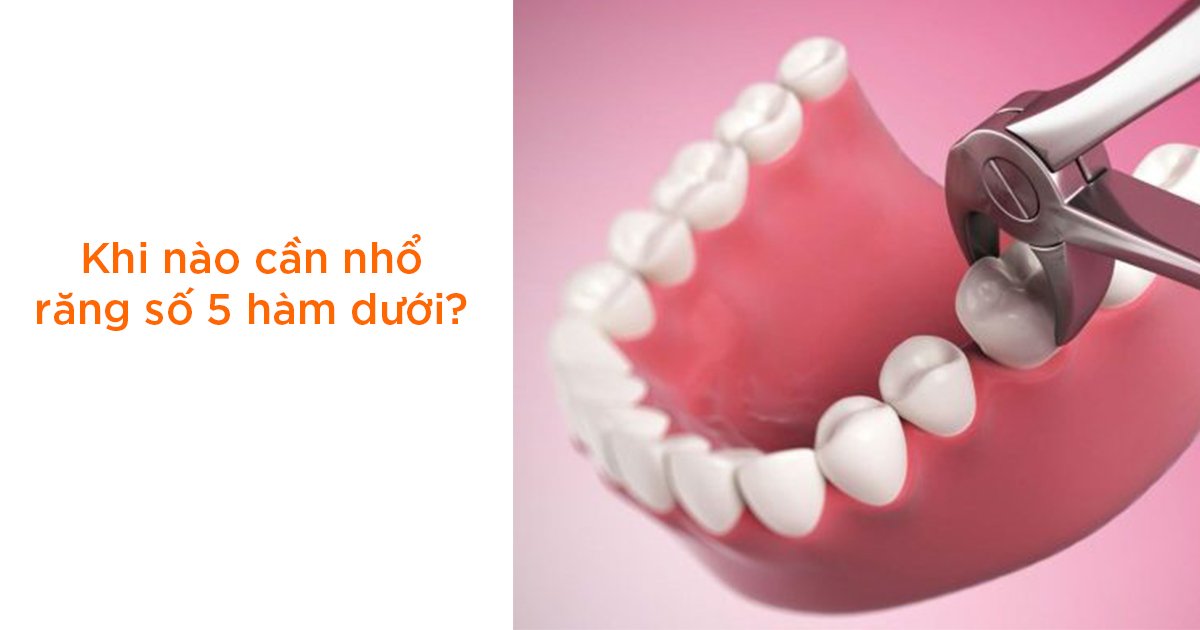 Khi nào cần nhổ răng số 5 hàm dưới?