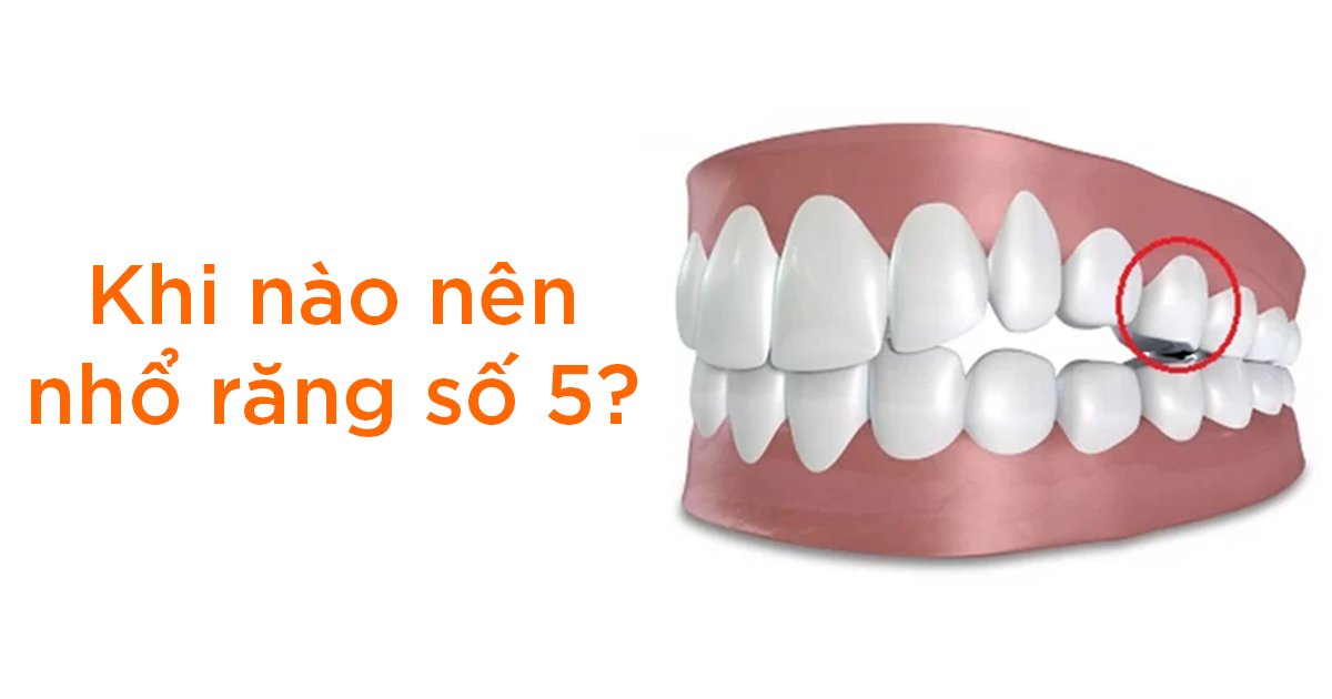 Khi nào nên nhổ răng số 5?