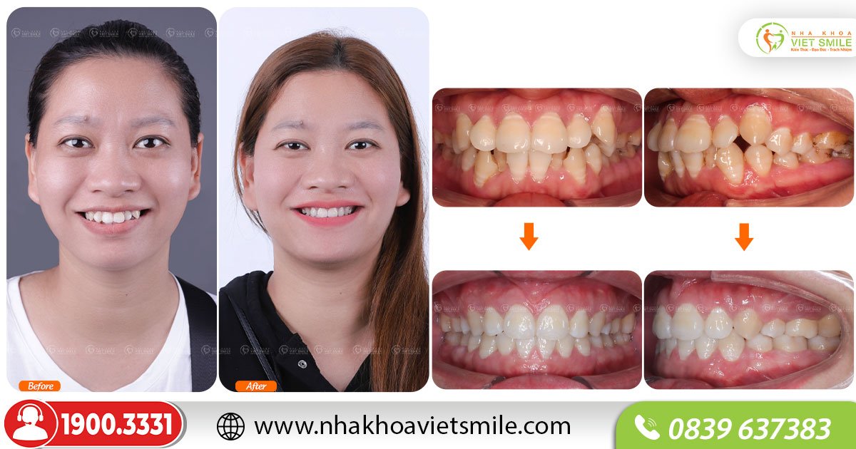Hình ảnh thay đổi của răng trước và sau niềng tại VIET SMILE