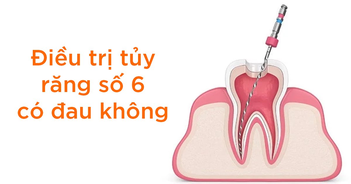 Điều trị tủy răng số 6 có đau không?