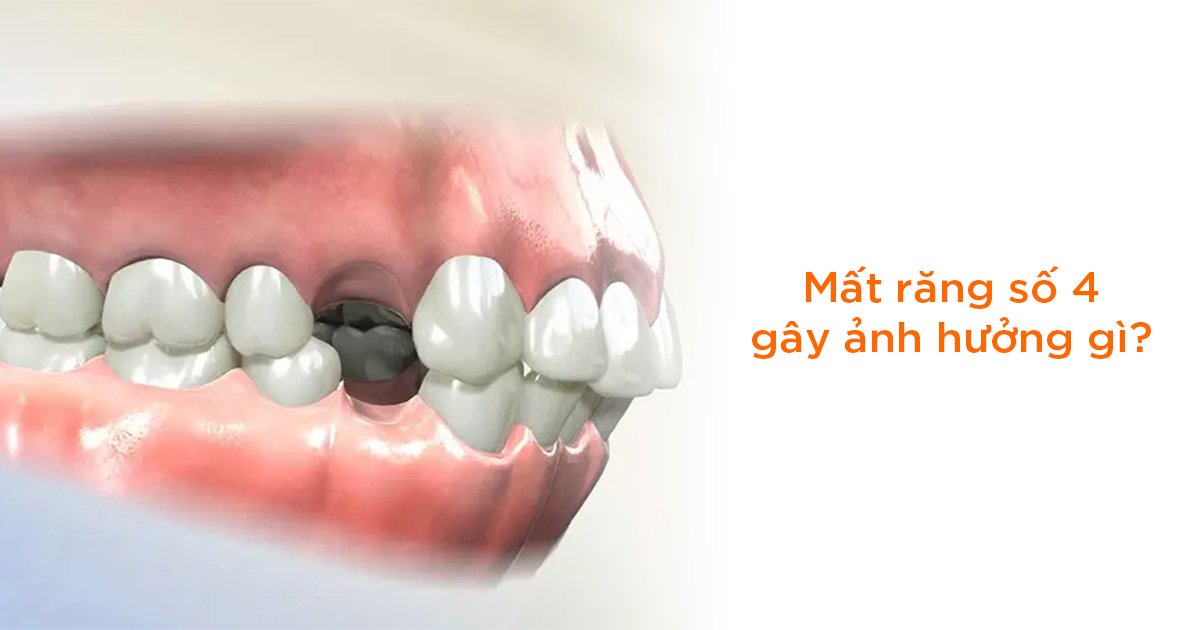 Mất răng số 4 gây ảnh hưởng gì?