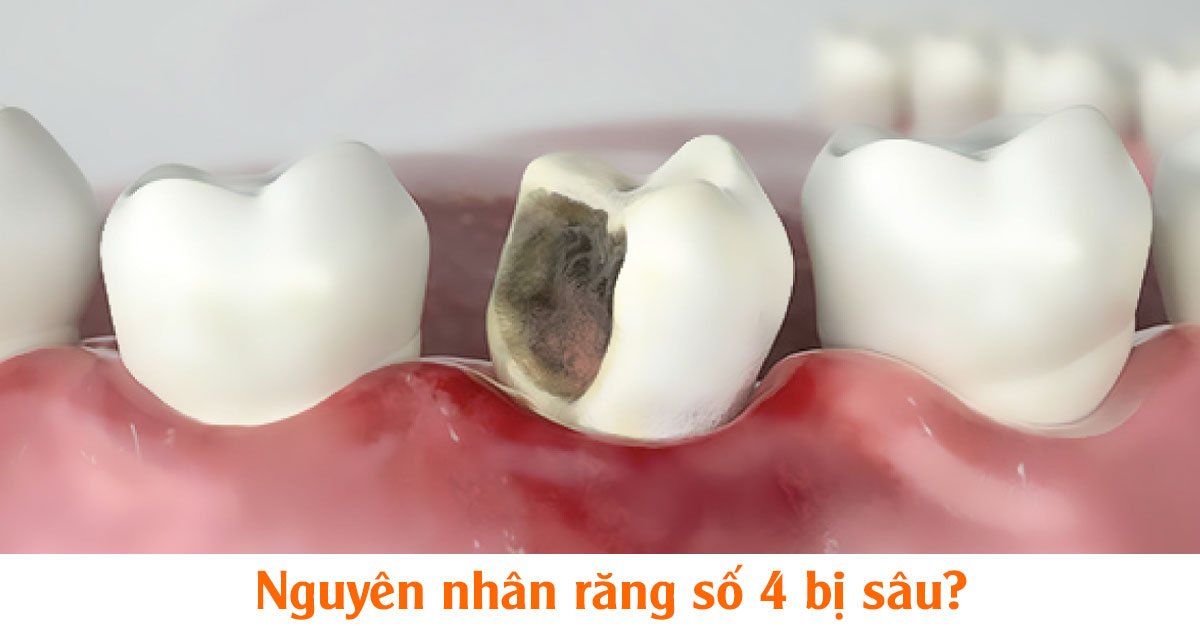 Nguyên nhân răng số 4 bị sâu?