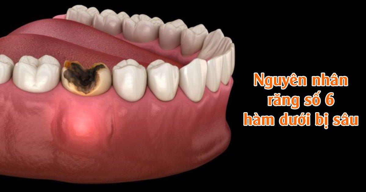 Nguyên nhân răng số 6 hàm dưới bị sâu