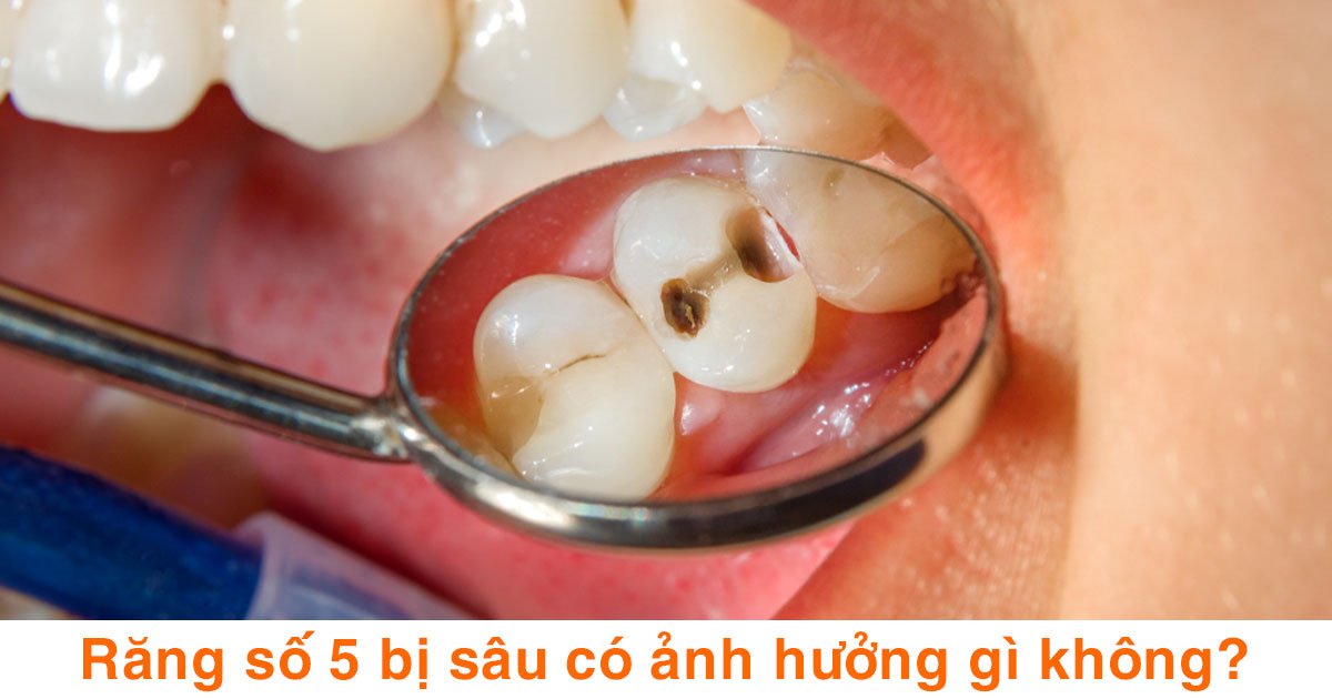 Răng số 5 bị sâu có ảnh hưởng gì không?