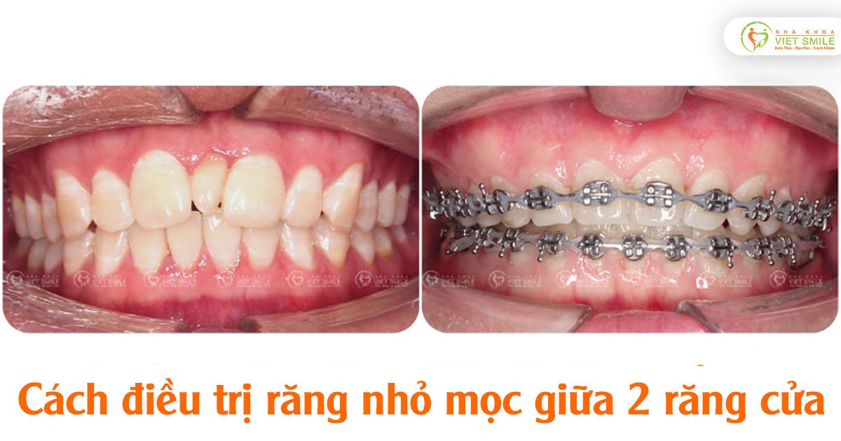 Cách điều trị răng nhỏ mọc giữa 2 răng cửa