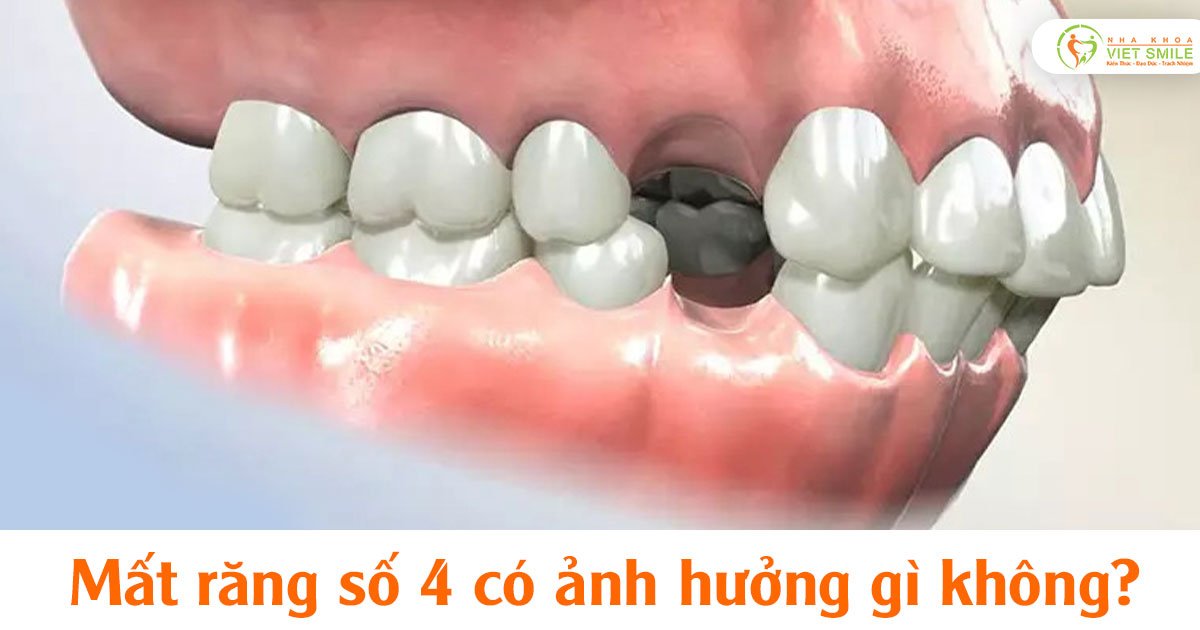 Mất răng số 4 có ảnh hưởng gì không?