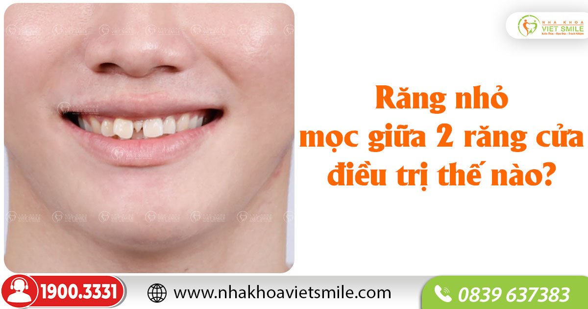 Răng nhỏ mọc giữa 2 răng cửa điều trị thế nào?