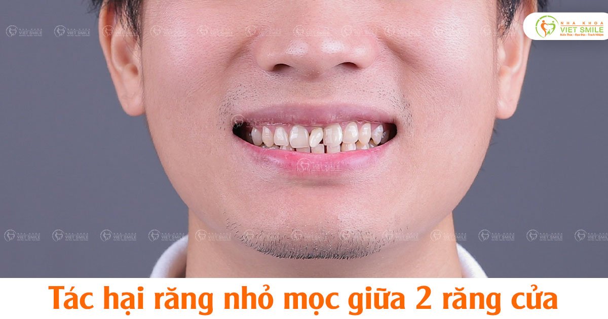 Tác hại răng nhỏ mọc giữa 2 răng cửa
