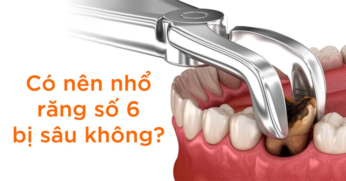 Có nên nhổ răng số 6 bị sâu không?