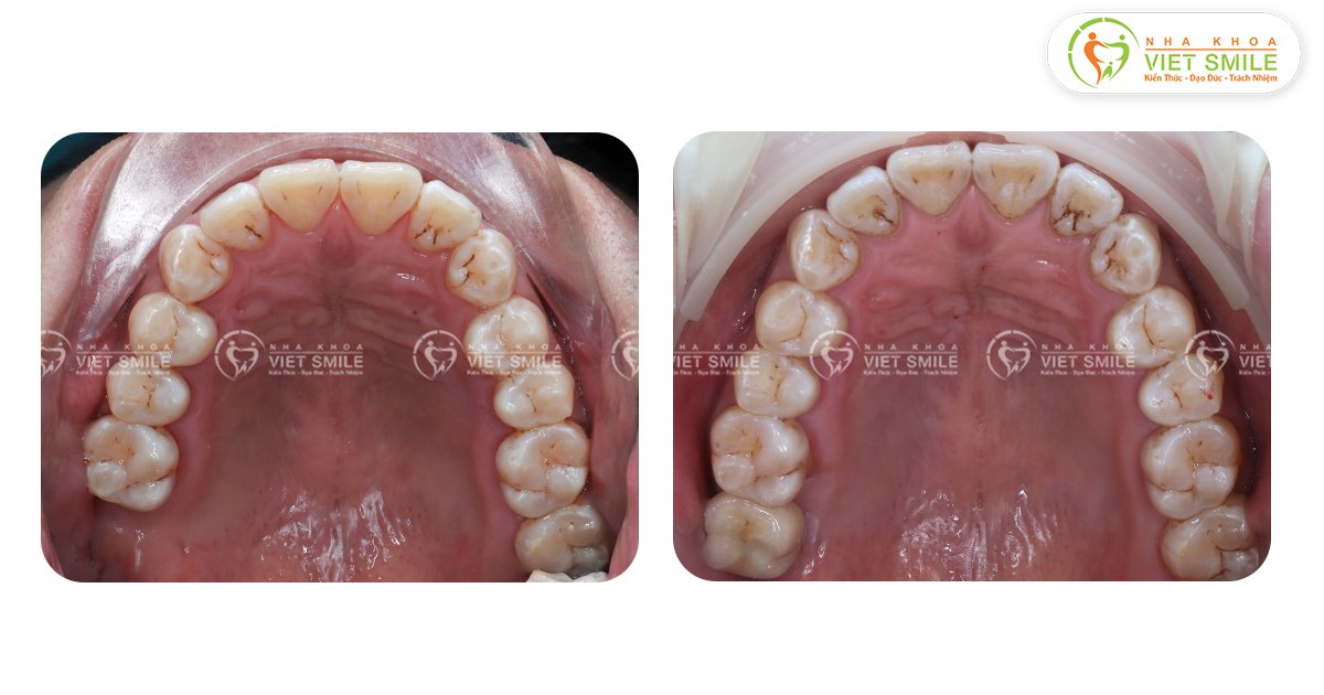 Hàm răng đầy đủ sau cấy implant