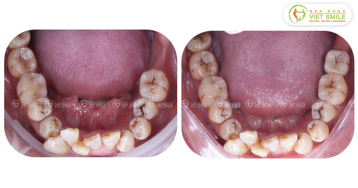 Cấy implant răng số 7 tại VIET SMILE