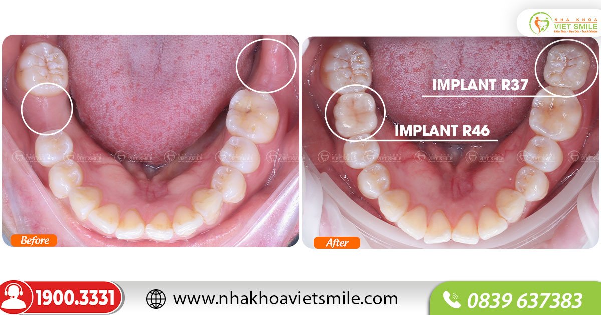 Hoàn thiện trồng implant 2 răng mất
