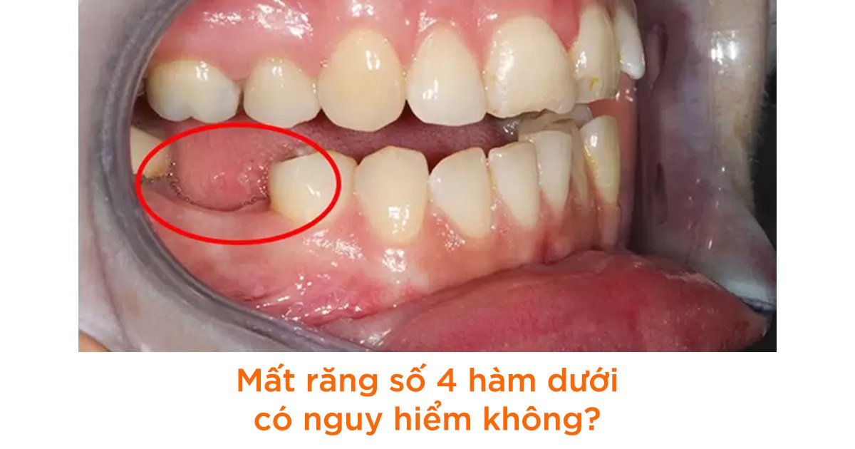 Mất răng số 4 hàm dưới có nguy hiểm không?
