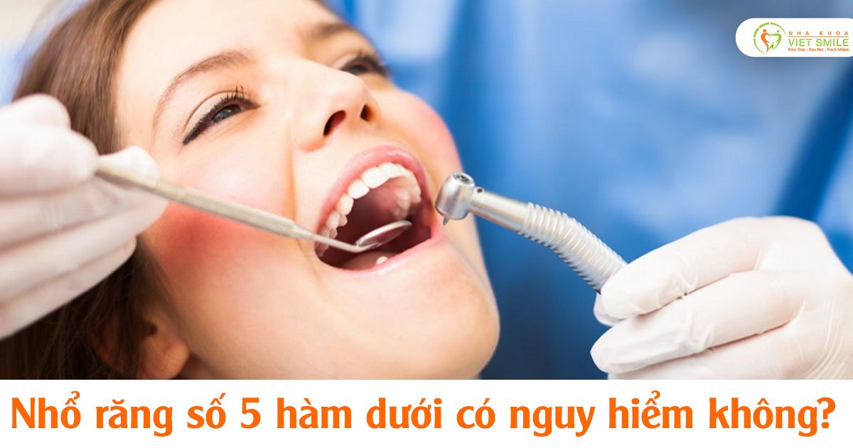 Nhổ răng số 5 hàm dưới có nguy hiểm không?