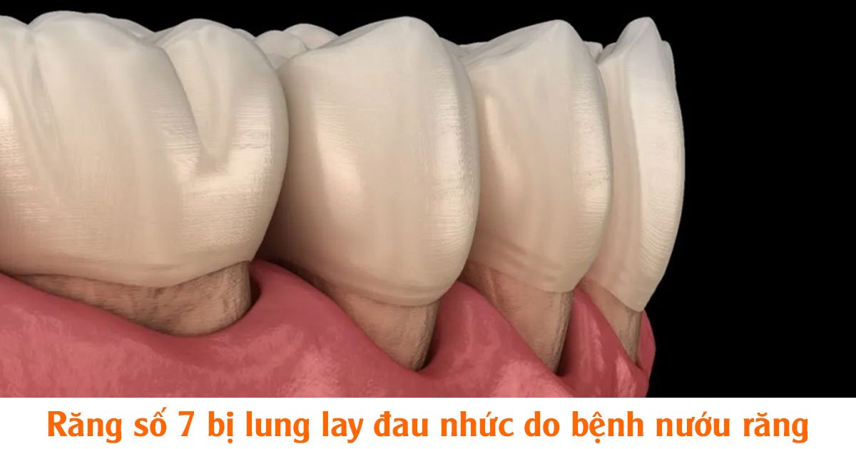 Răng số 7 bị lung lay đau nhức do bệnh nướu răng