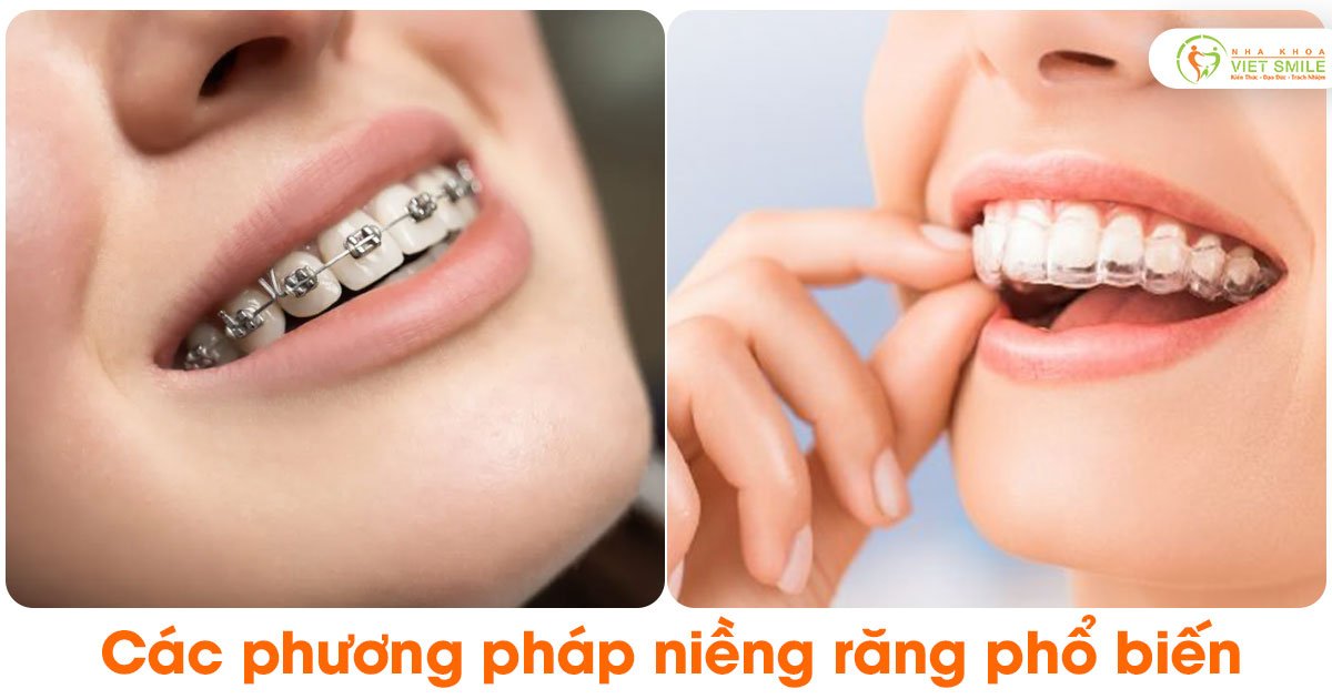 Các phương pháp niềng răng phổ biến