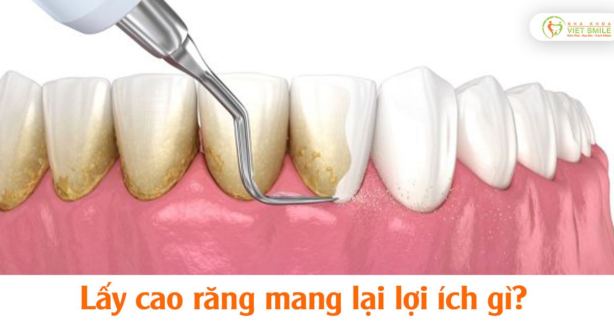 Lấy cao răng mang lại lợi ích gì?