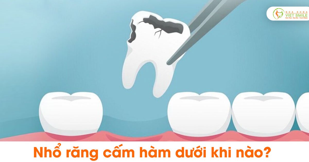 Nhổ răng cấm hàm dưới khi nào?