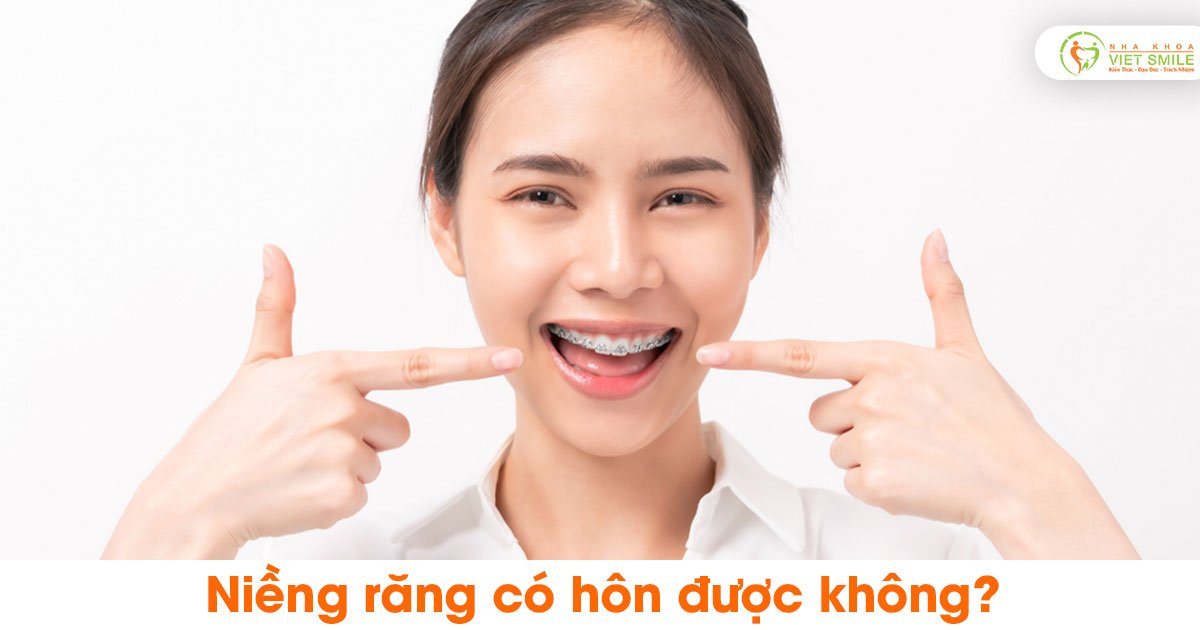 Niềng răng có hôn được không?