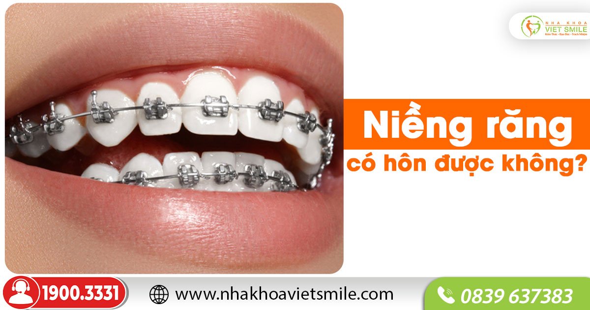 Niềng răng có hôn được không?