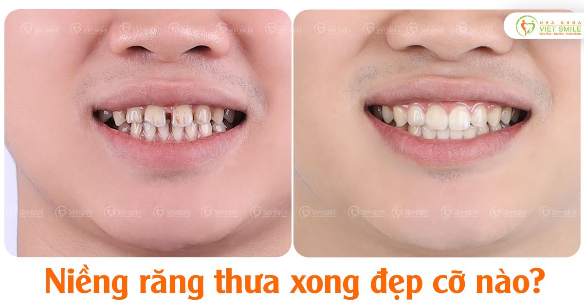 Niềng răng thưa xong đẹp cỡ nào?
