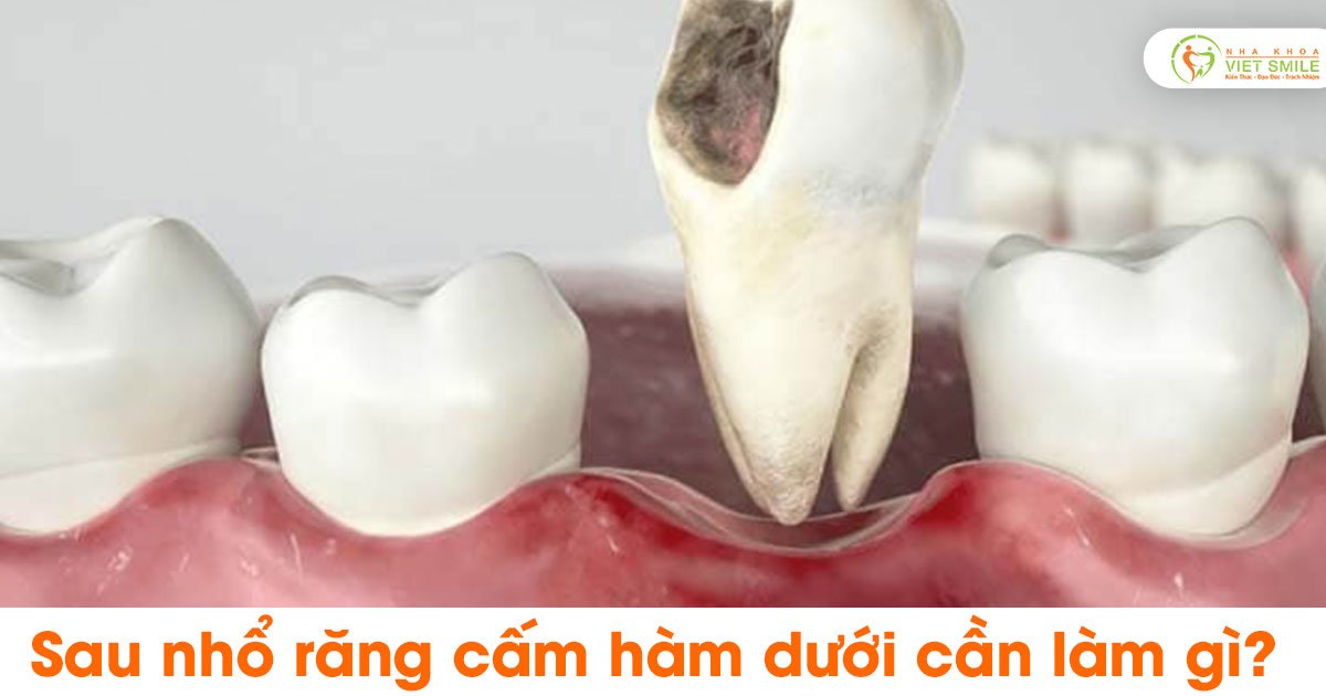 Sau nhổ răng cấm hàm dưới cần làm gì?