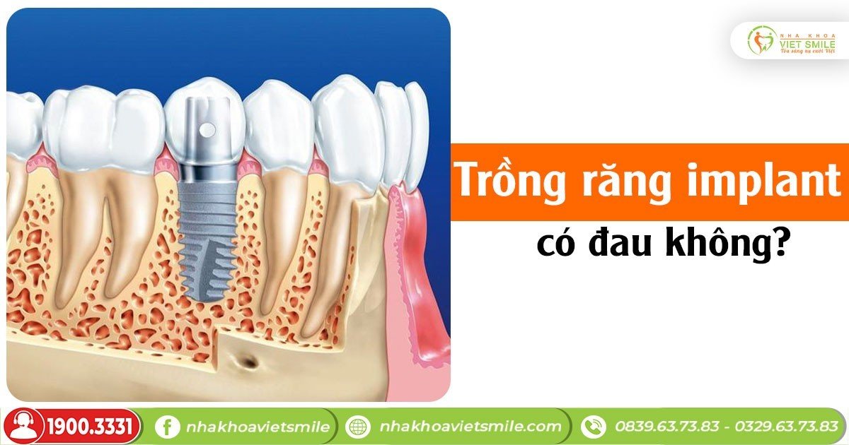 Trồng implant có đau không?