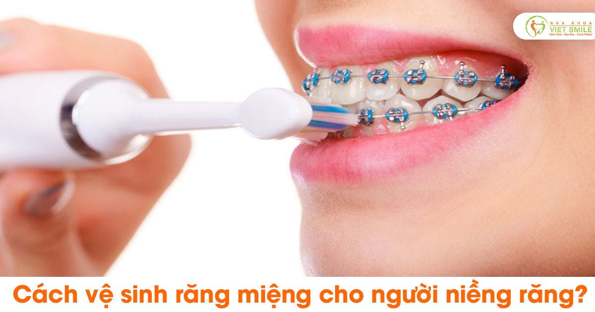 Cách vệ sinh răng miệng cho người niềng răng?