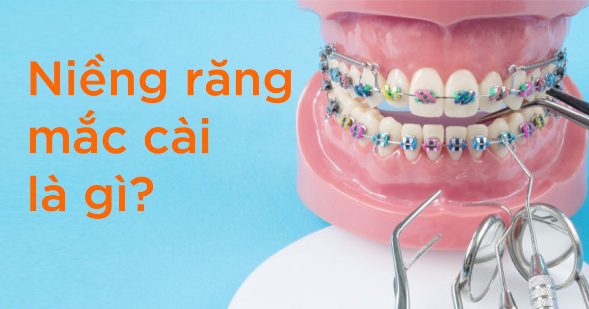 Niềng răng mắc cài là gì?