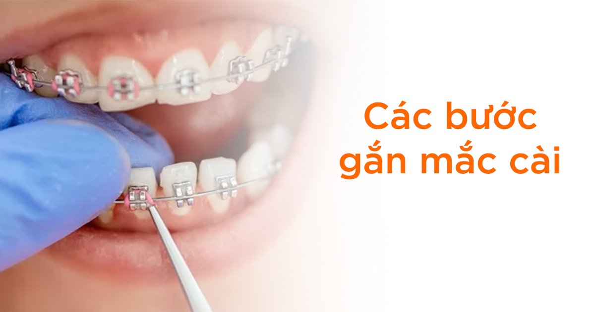 Vị trí gắn mắc cài