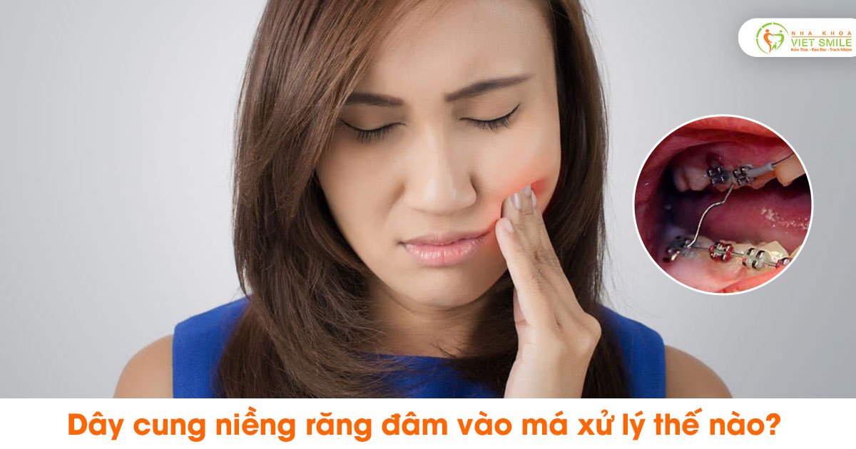 Dây cung niềng răng đâm vào má xử lý thế nào?