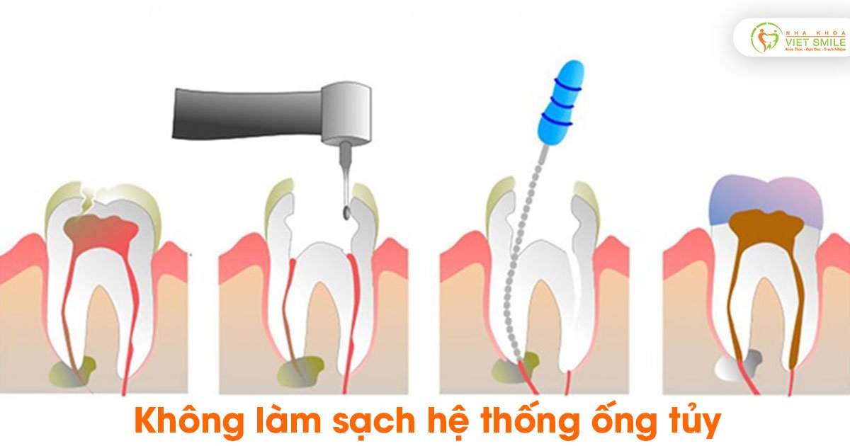 Không làm sạch hệ thống ống tủy