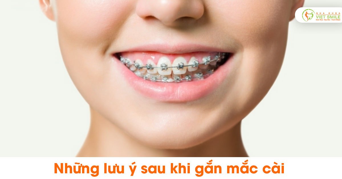 Những lưu ý sau khi gắn mắc cài