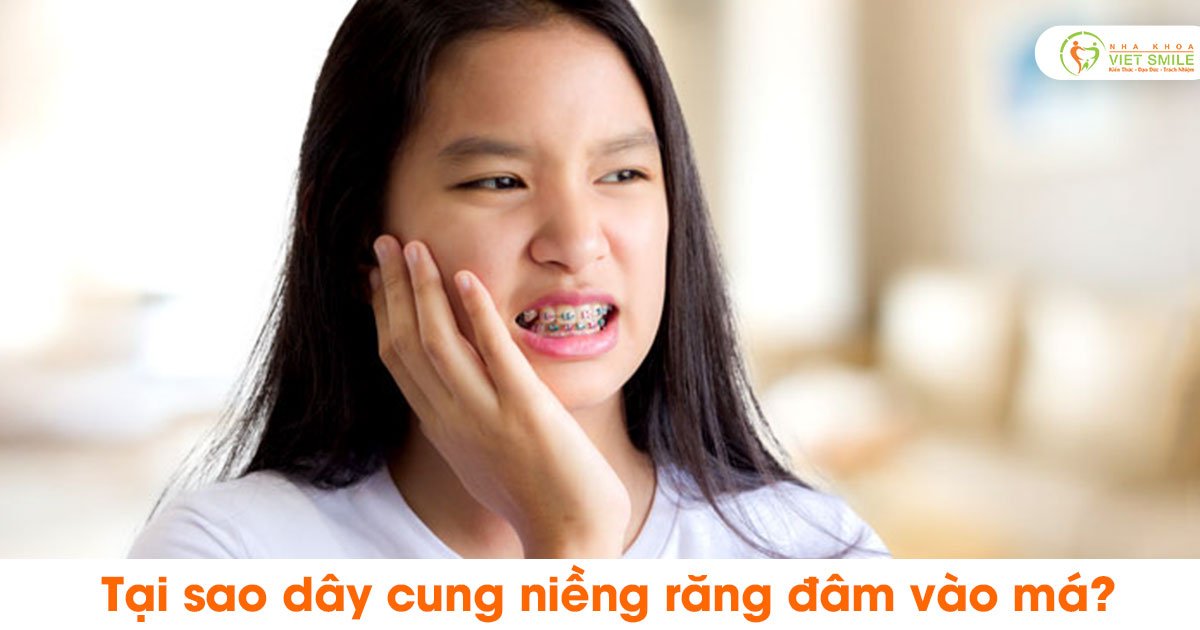 Tại sao dây cung niềng răng đâm vào má?