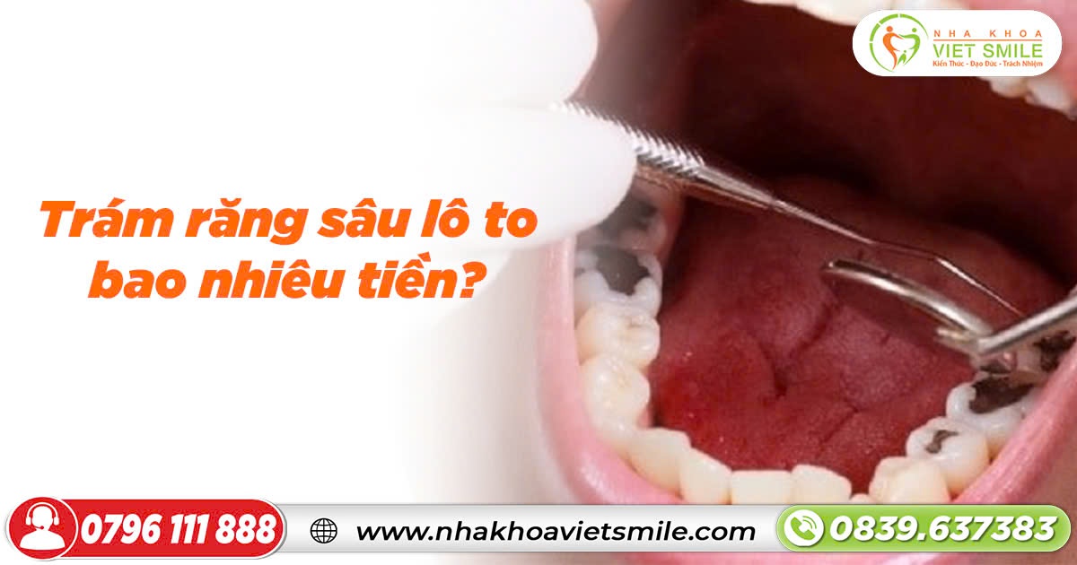 Trám răng sâu lỗ to bao nhiêu tiền?