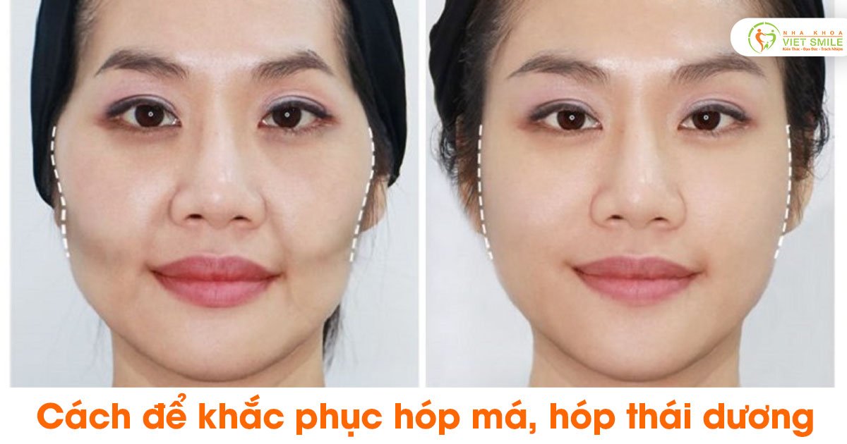 Cách để khắc phục hóp má, hóp thái dương