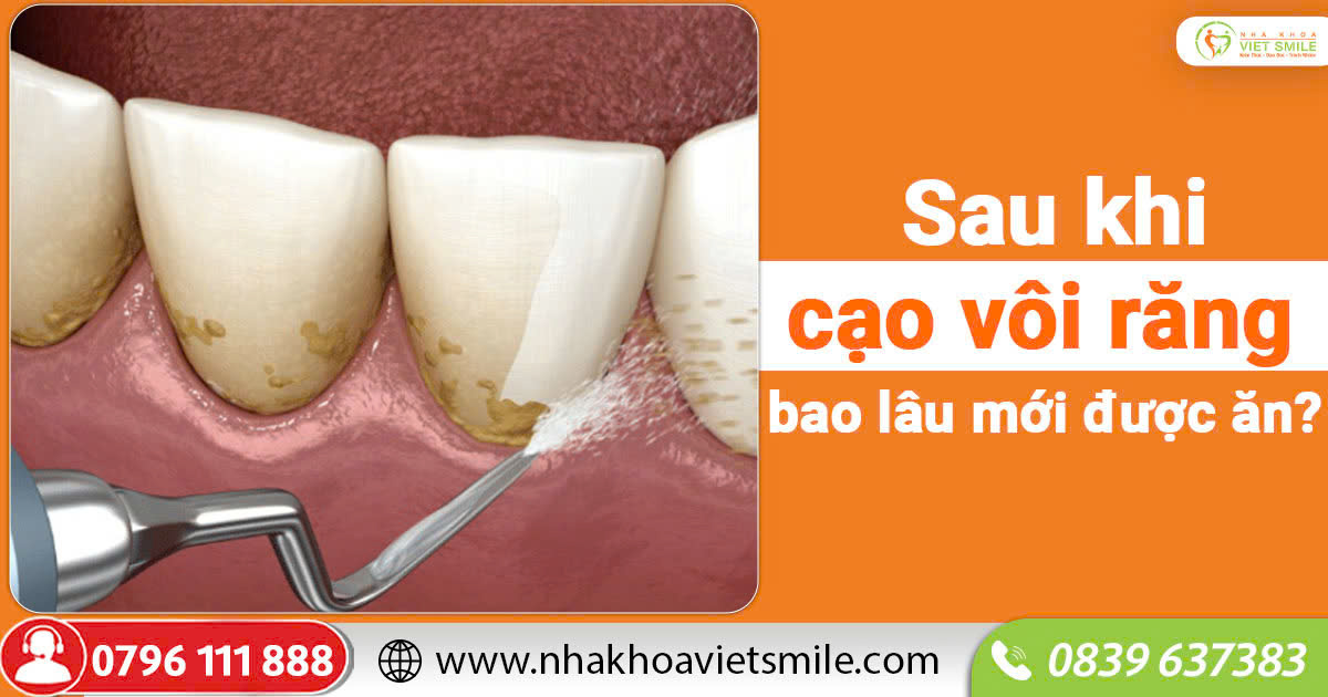 Sau khi cạo vôi răng bao lâu mới được ăn?