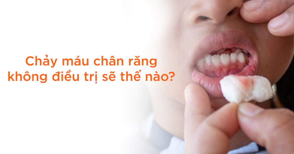 Chảy máu chân răng không điều trị sẽ thế nào?