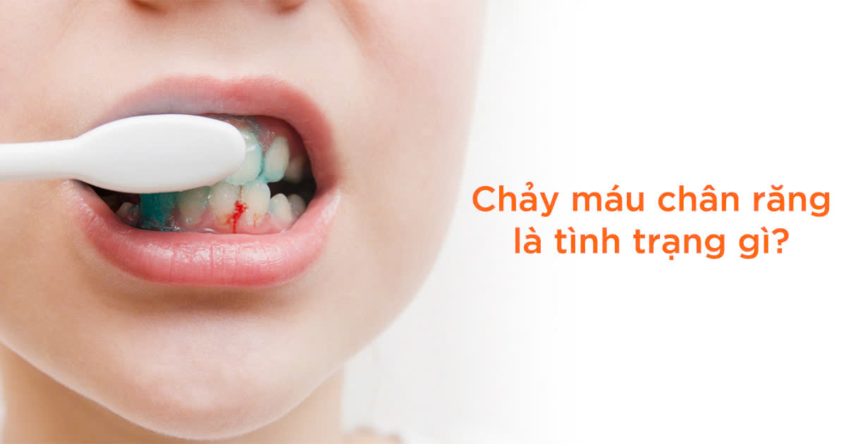 Chảy máu chân răng là tình trạng gì?