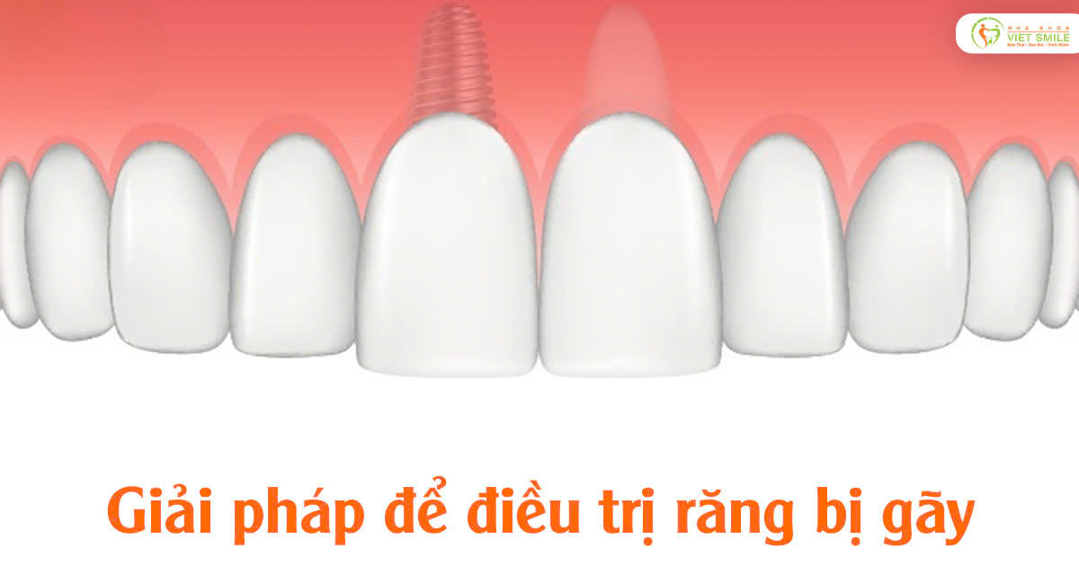 Giải pháp để điều trị răng bị gãy