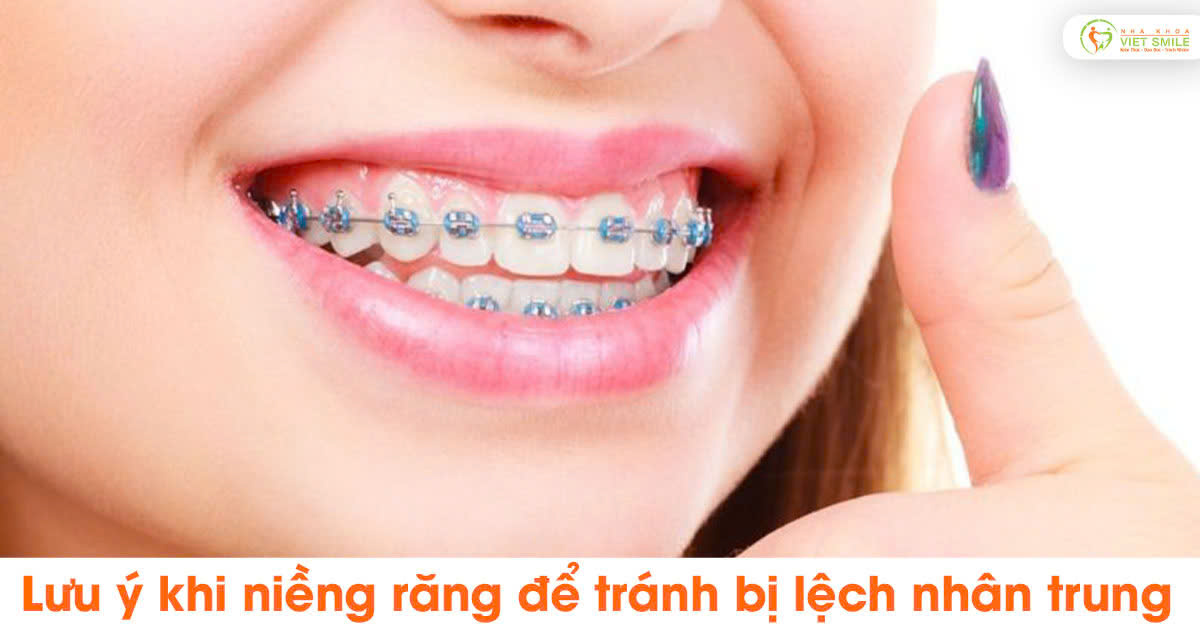 Lưu ý khi niềng răng để tránh bị lệch nhân trung