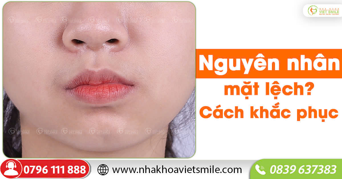 Nguyên nhân mặt lệch? Cách khắc phục