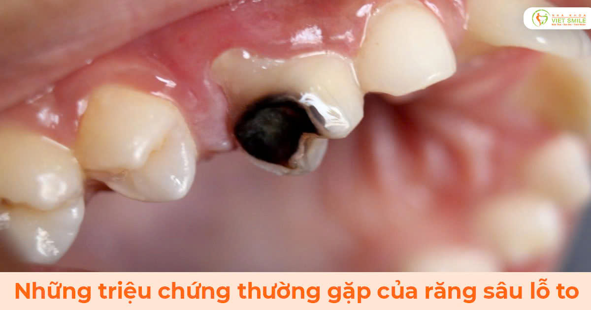 Những triệu chứng thường gặp của răng sâu lỗ to